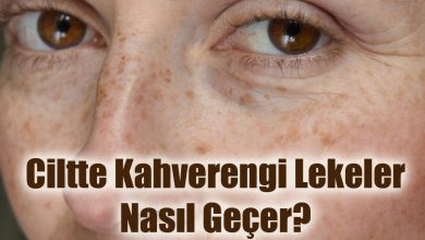 Ciltte Kahverengi Lekeler Nasıl Geçer?