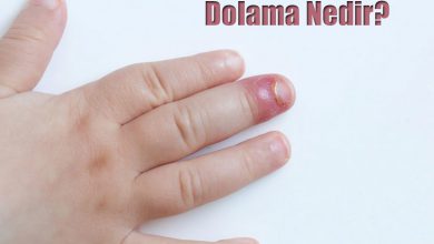 Dolama Nedir? Nasıl Tedavi Edilir?