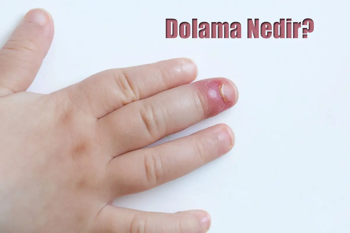 Dolama Nedir? Nasıl Tedavi Edilir?