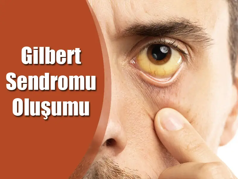 Gilbert Sendromunun Oluşumu