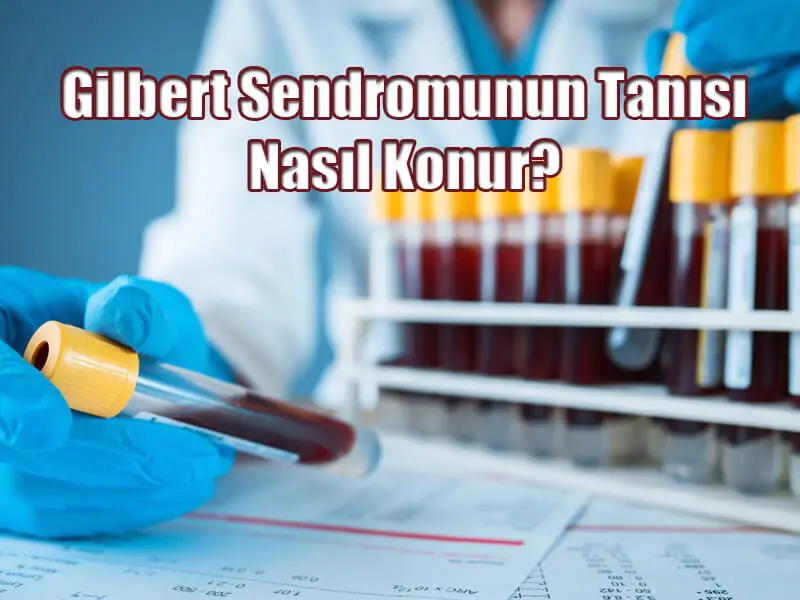 Gilbert Sendromunun Tanısı Nasıl Konur?