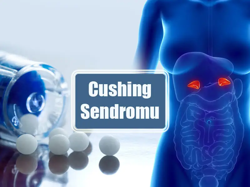 Cushing Sendromu Belirtileri Nelerdir?