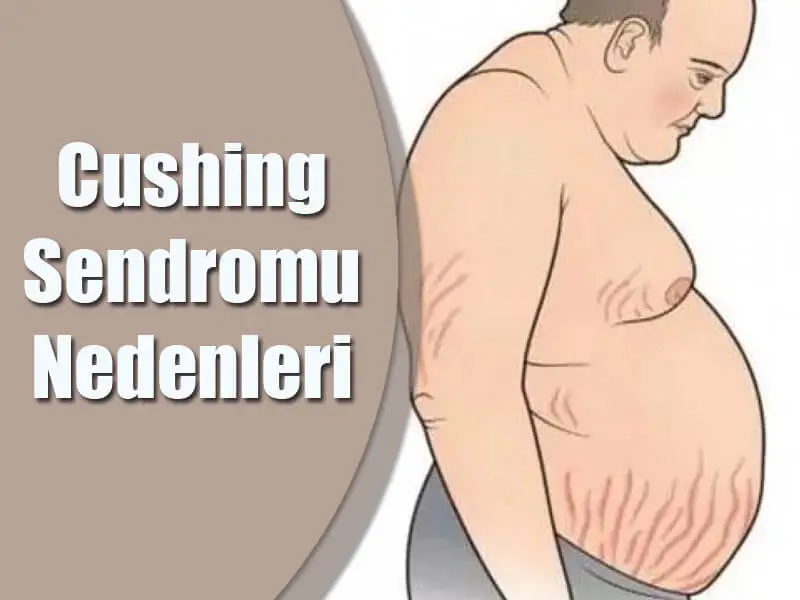 Cushing Sendromu Nedenleri Nelerdir?