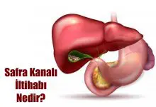 Kolanjit (Safra Kanalı İltihabı) Nedir?