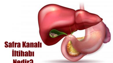 Kolanjit (Safra Kanalı İltihabı) Nedir?