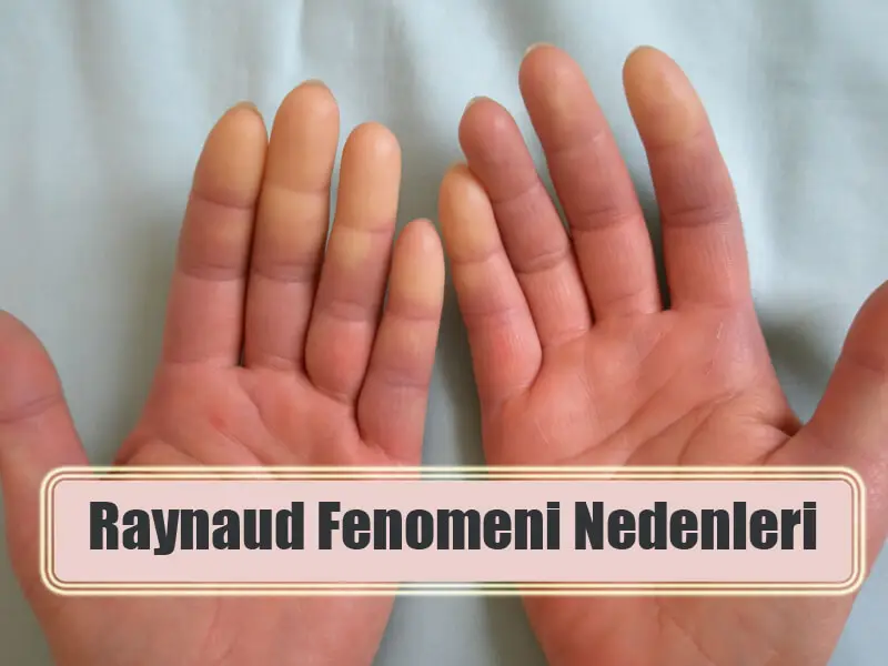 Raynaud Fenomeni Nedenleri