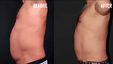 LIPOSUCTION İLE FAZLA YAĞLARA KALICI ÇÖZÜM 2025