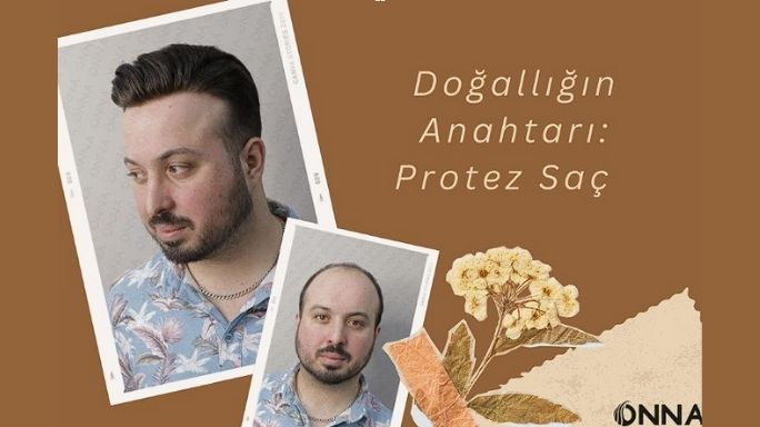 Onna Hair Protez Saç